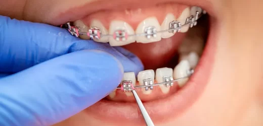 Navigating Orthodontic Treatment as a Family in Monterey Park